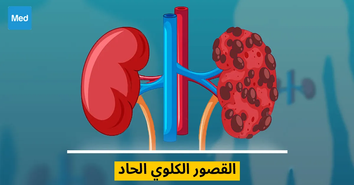 القصور الكلوي الحاد